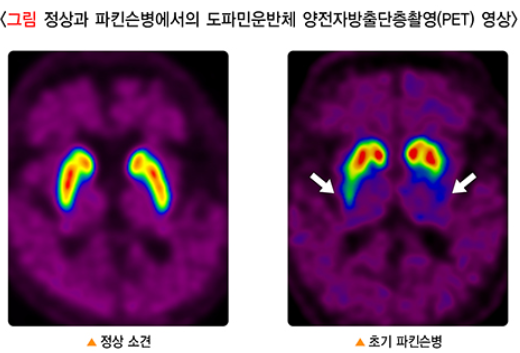 출처; 국가건강정보포털, 파킨슨병 도파민운반체 영상