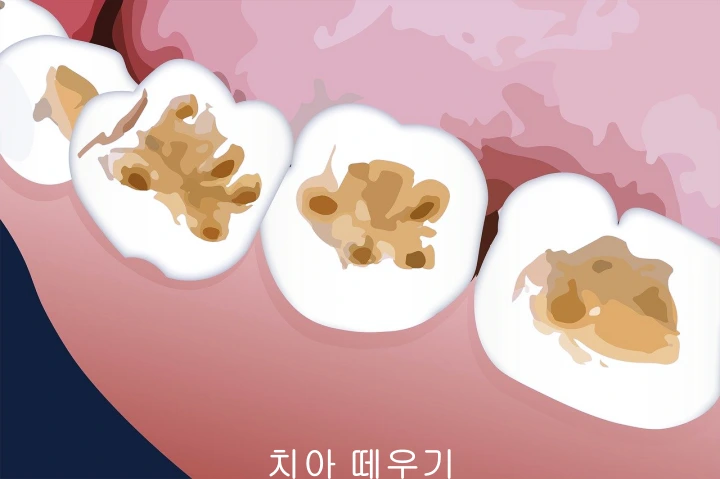 치아-때우기