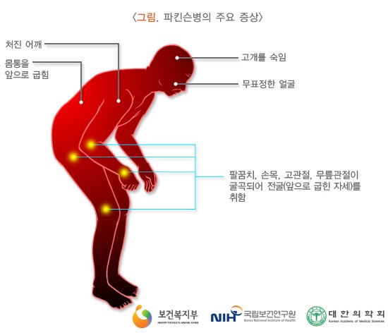  파킨슨병[ Parkinson’s disease ]