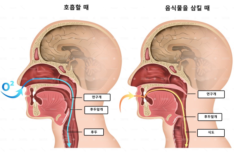 호흡할 때와 음식물을 삼킬 때 연구개의 위치 비교