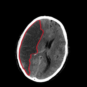  뇌경색 [Cerebral Infarction]