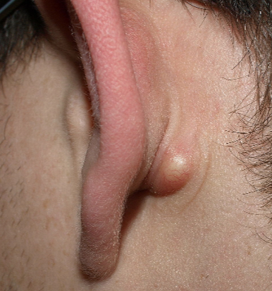 귀 뒤에 생긴 염증성 피지낭종