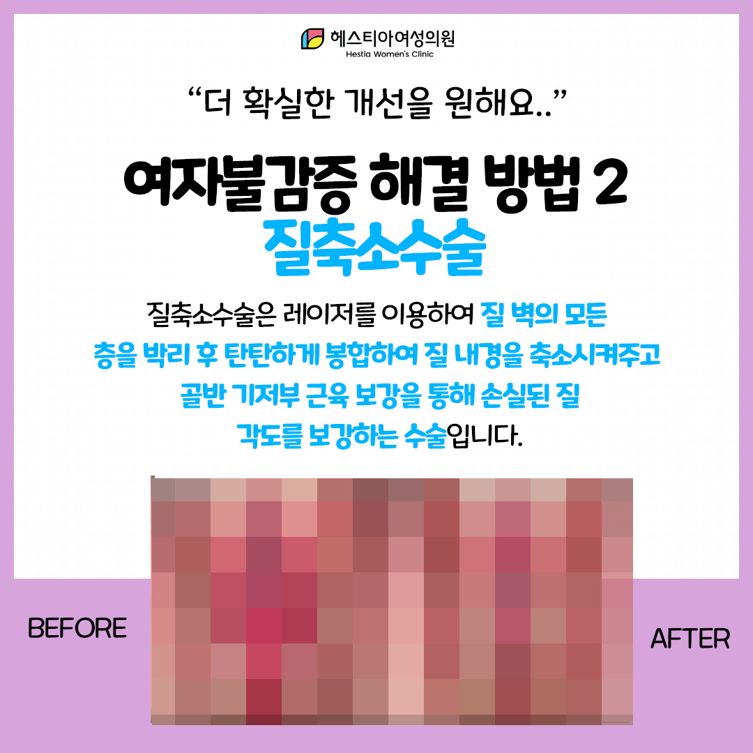 여자 불감증
더 확실한 해결 방법: 예쁜이수술