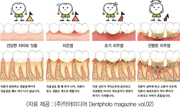 흔들리는 치아 - 치주염