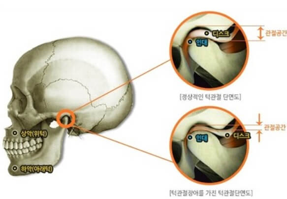  턱관절 통증 치료 방법