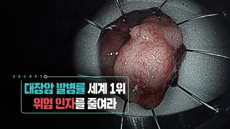  생로병사의 비밀 대장암 발병률 세계 1위 이유 원인 식습관 배변습관 직장출혈 장내세균 푸소박테리움 술 위험 인자 식단 858회