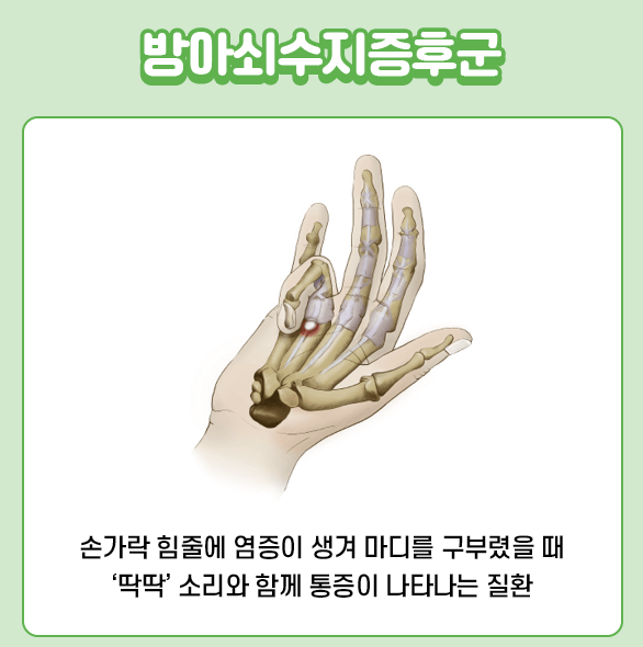 방아쇠수지증후군