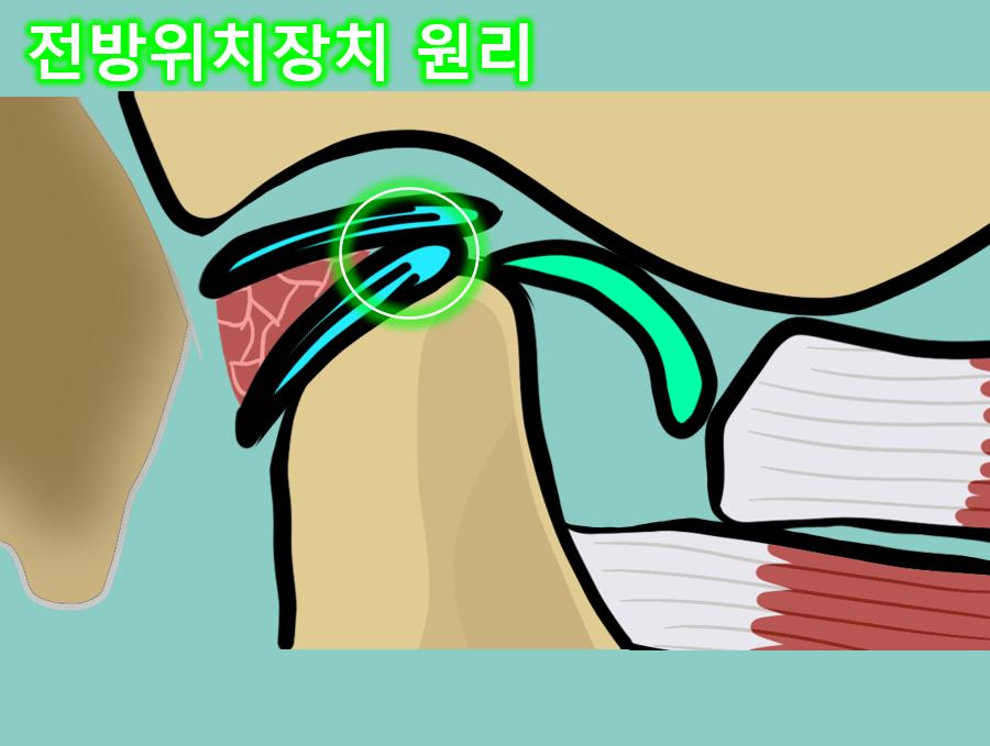 개구장애 치료와 턱관절 스플린트 원리, 구강내과 의사가 알려드림