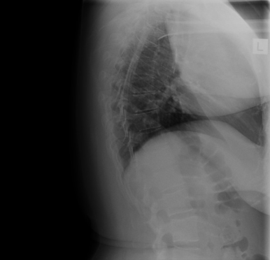 ULL 무기폐의 Lateral view