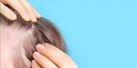  탈모 (Hair Loss)의 원인과 치료방법