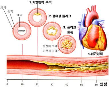 심근경색증 증상