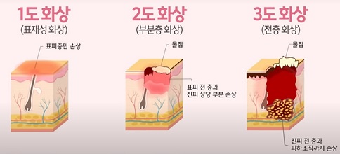 화상 단계별 분류