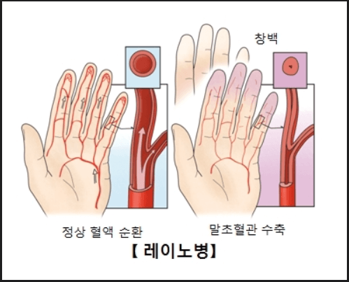 레이노증후군