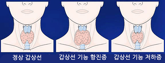 정상 갑상선