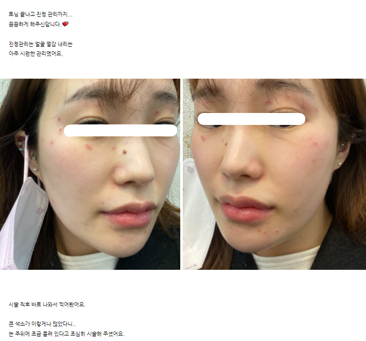 레이저토닝 후기