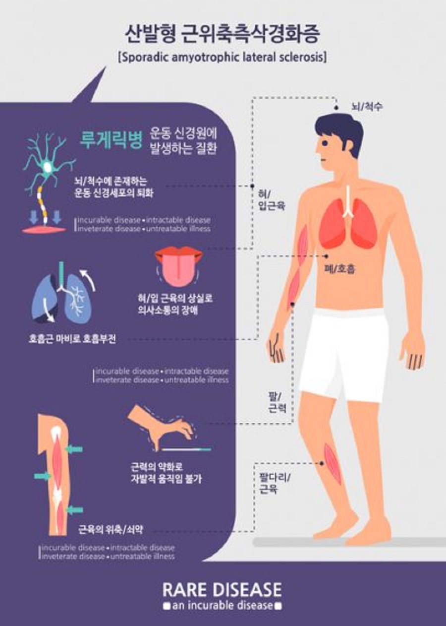 산발형 근위축측삭경화증