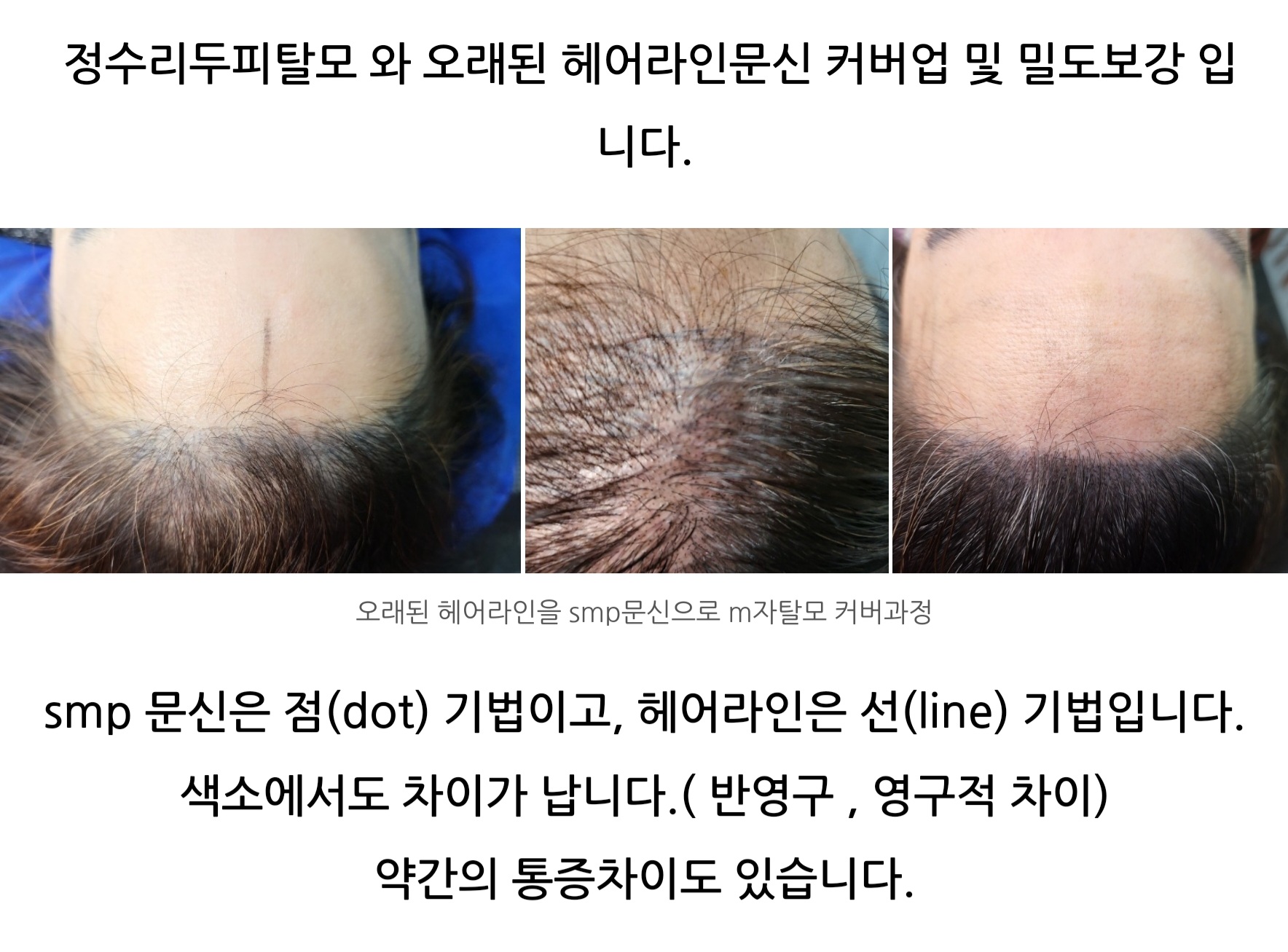  오래된 헤어라인문신 전주 두피문신으로 커버했어요!!!
