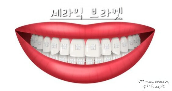 세라믹 브라켓