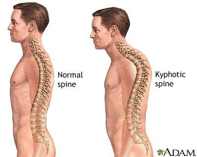 척추후만증(kyphotic spine)