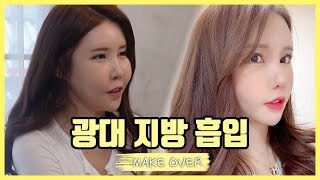  성형실패 하고 광대지방 많으신 분들 꼭 보세요 [얼굴지방흡입+앞광대지방흡입]