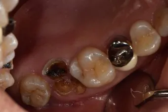 어금니 칫솔 사용법 선택방법 실사용 후기_10