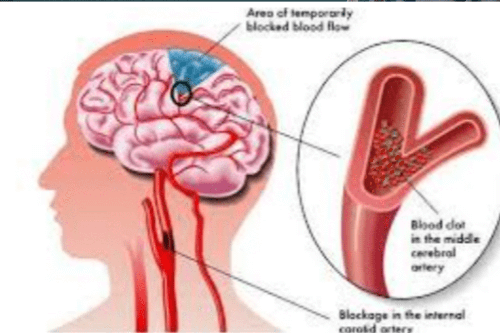 뇌혈관이 혈전이 쌓이는 모습
