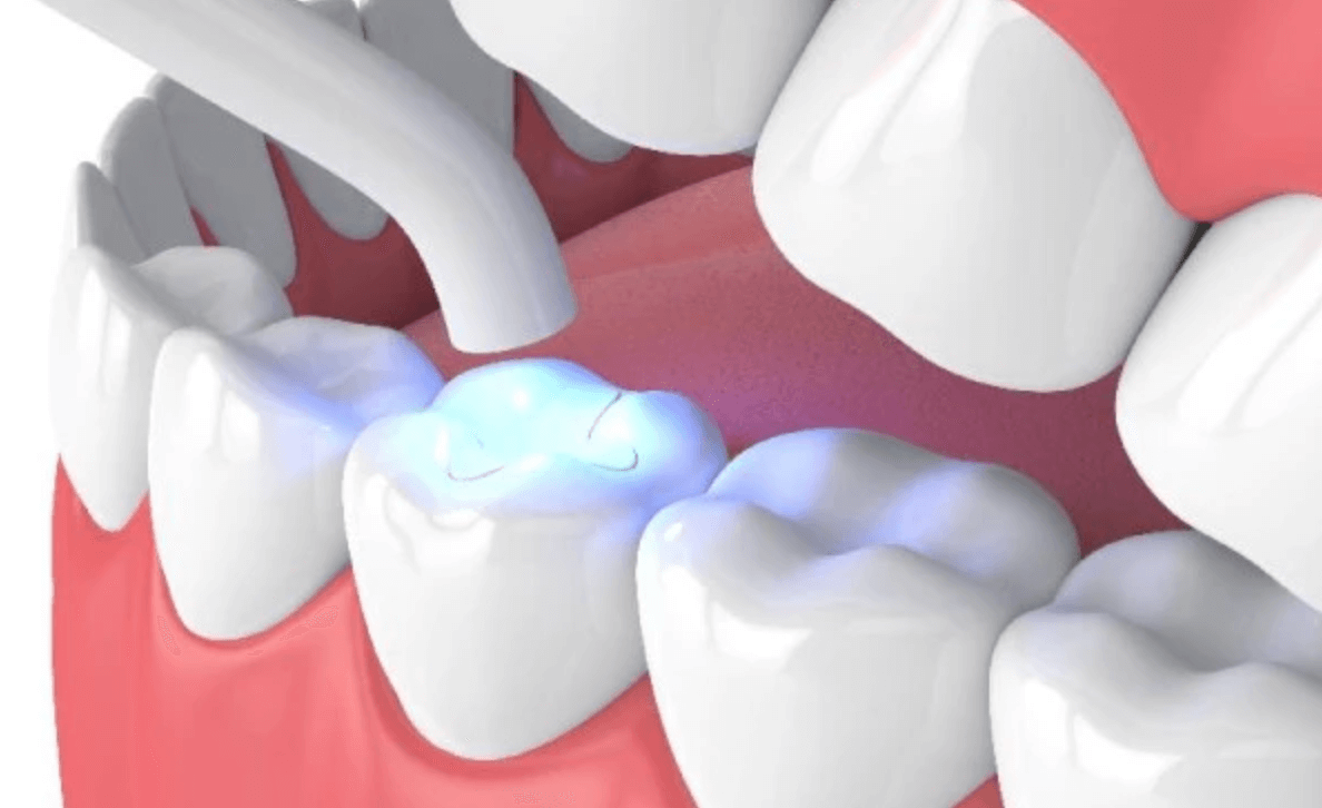 치아 치료