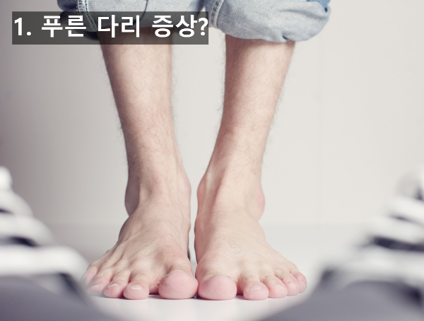  코로나 새 후유증, 푸른 다리 증상은?