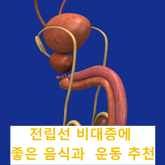 전립선비대증에 좋은 음식과 운동