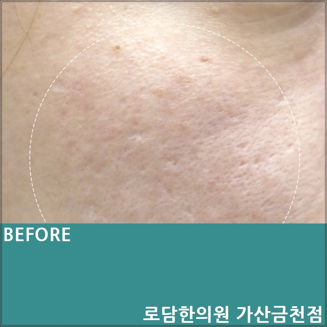  부천 여드름 흉터 제거 패인 자국 피부 복원 새살침
