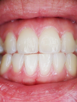 치아보존치료