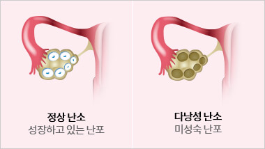 정상난소와 다낭성난소 비교그림