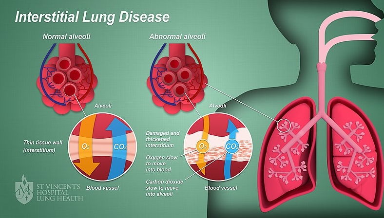 만성 폐쇄성 폐질환(COPD)