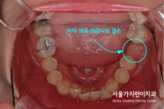 어금니 칫솔 사용법 선택방법 실사용 후기_19