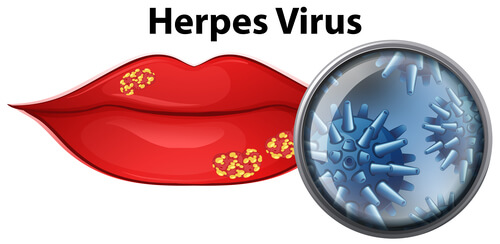 herpes-lip-virus