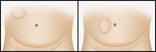 탈장 [hernia] 그 종류와 증상의외로 많아"소아