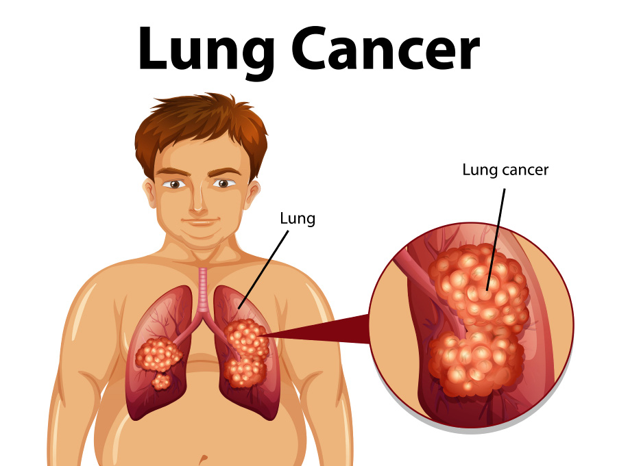 사람의 폐와 폐에 발생된 폐암의 형태와 발생부위를 이미지한 그림을 찍은 사진