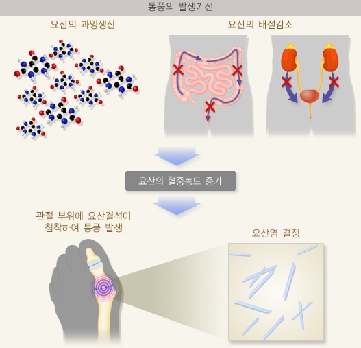 통풍의 발생기전