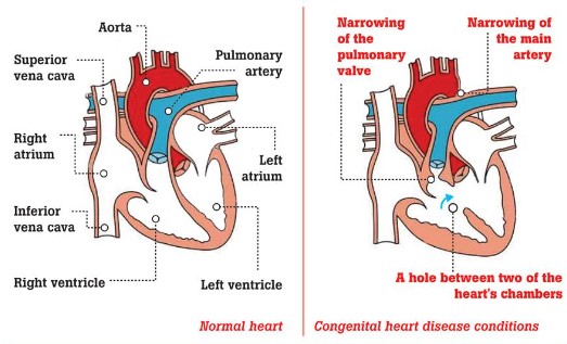 선천성 심장 결함 Congenital heart defect