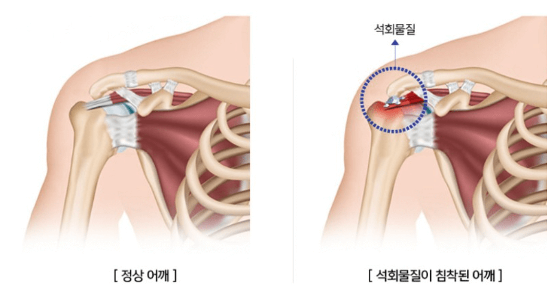 어깨 석회질치료방법, 어깨 석회성 건염 증상과 원인은 무엇? - 하이웨이