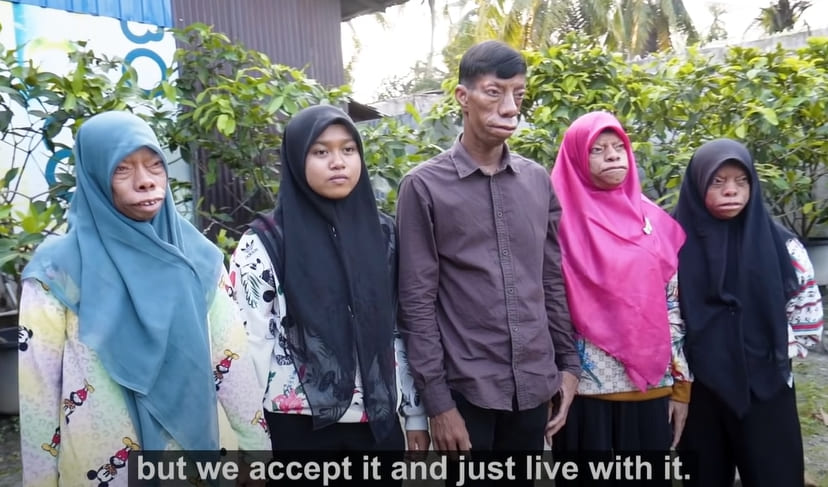  인도네시아 북부 수마트라에 사는 한 가족은 얼굴 모양이 변하는 희귀한 질병을 가지고 살고 있다