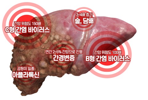  간질환 '간암'에 대한 모든것!