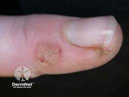 HPV 