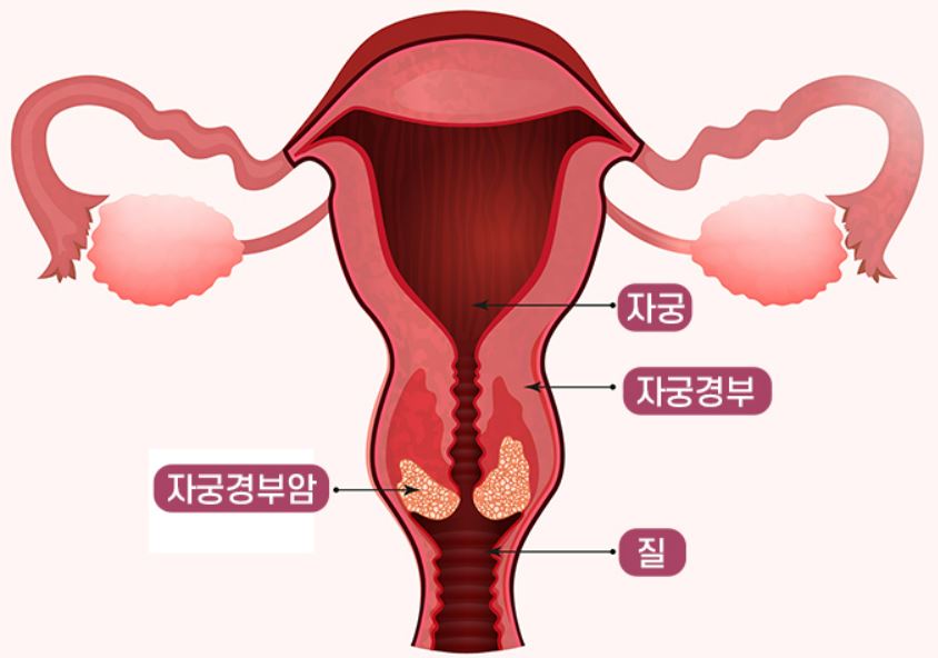 자궁경부