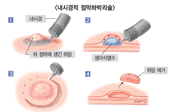 위암 증상