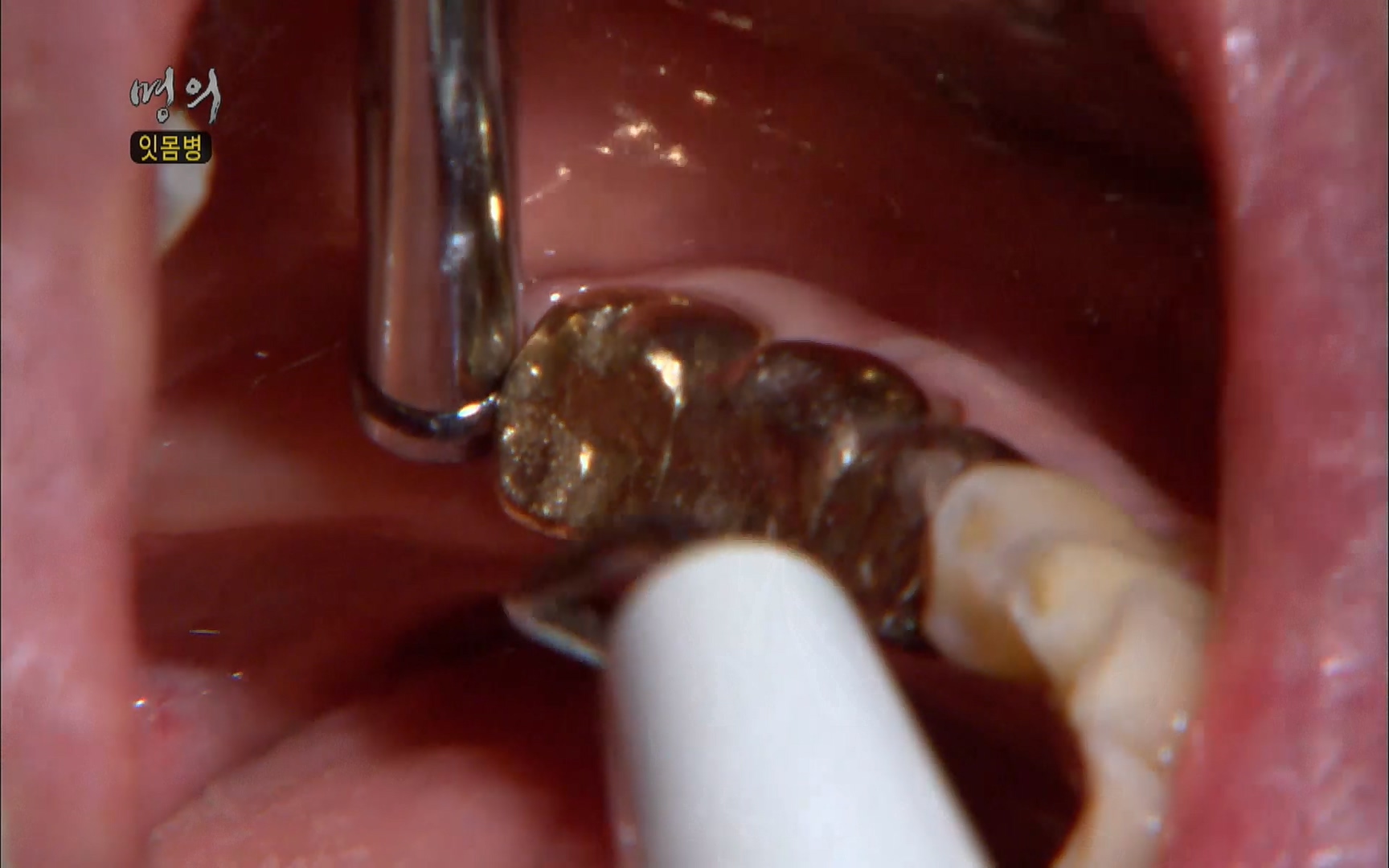 EBS 명의 헬스케어 - TV - 교육의 중심 EBS2015년 1월 16일 (금) 밤 9시 50분, EBS1.mp4_20220505_150404.086.jpg