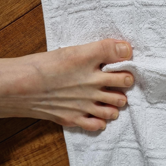 족저근막염 환자는 발가락은 외전(옆으로 벌려서)하여 수건을 잡도록 하면 발바닥 근육의 활성이 증가되어 발바닥 통증에 도움을 줄 수 있습니다. 