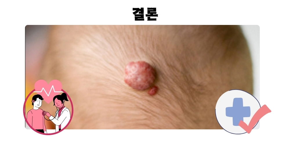 혈관종 12