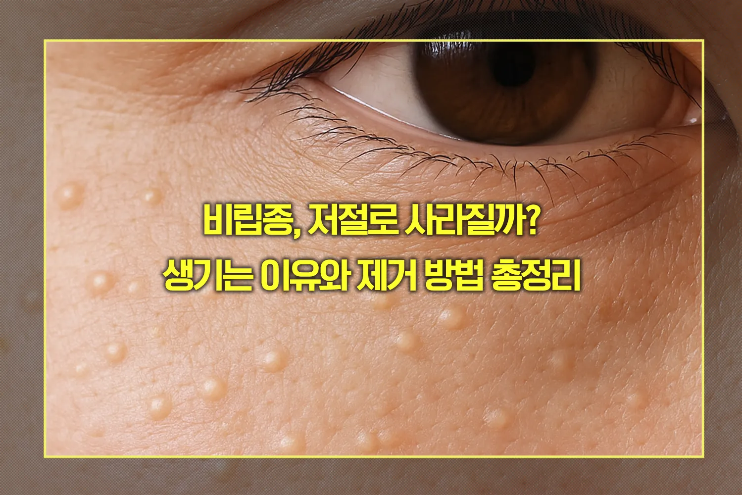 비립종 생기는 이유와 제거 방법