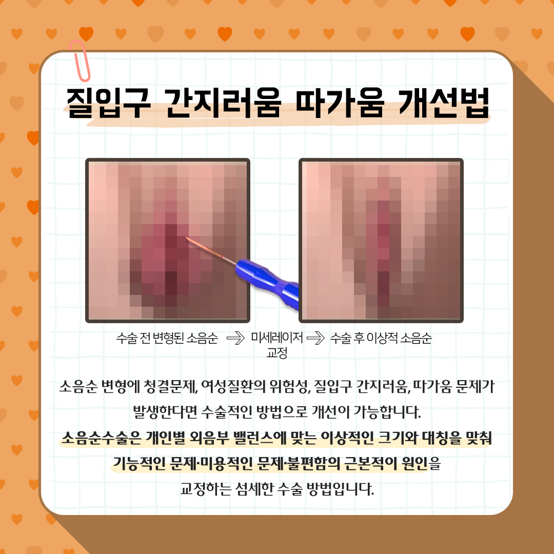 미금산부인과 질입구간지러움 따가움 수술로 치료 가능한가요?